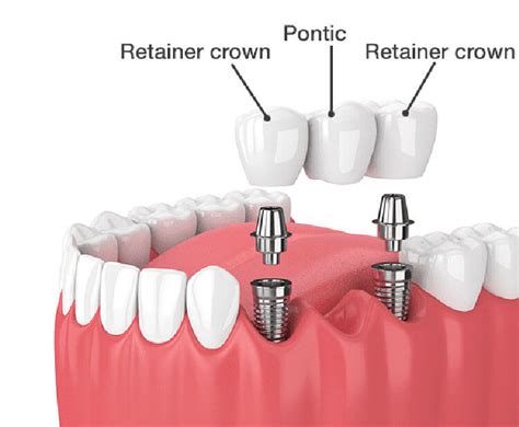 Dental Implant Bridge Fabrication