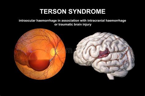 Terson Syndrome Stock Illustrations – 17 Terson Syndrome Stock ...