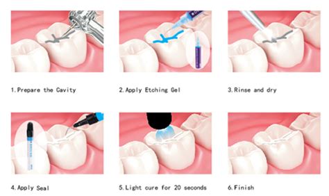 Dental Fissure Sealants in Singapore - B & F Dental Clinic Singapore