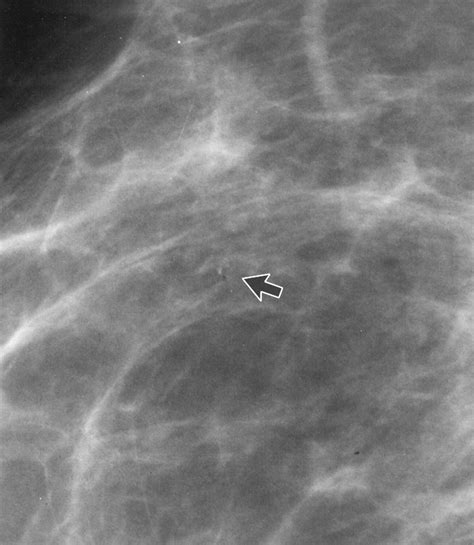 Retrieval of Lost Microcalcifications During Stereotactic Vacuum-Assisted Core Biopsy | AJR