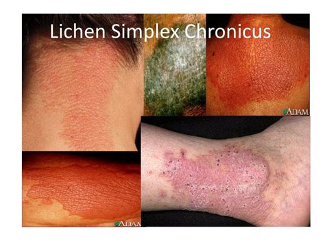 PPT - Lichen Simplex Chronicus PowerPoint Presentation, free download ...