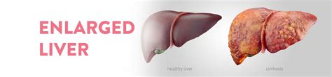 All about Enlarged Liver - CK Birla Hospital