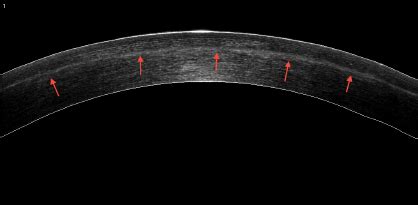 Anterior segment OCT image of a treated cornea. Note: There is... | Download Scientific Diagram