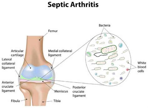 What is Septic Arthritis - Symptoms, Causes & Treatment