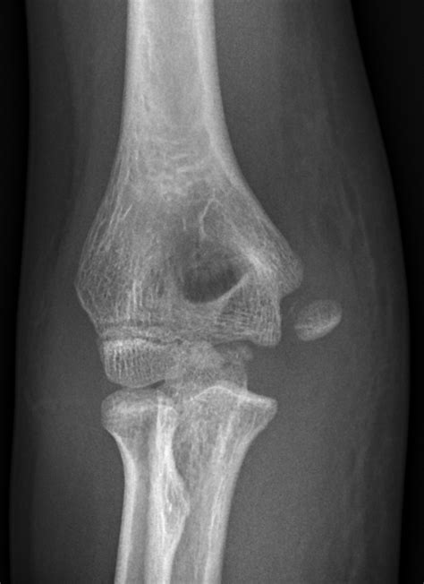 Lateral Epicondyle Avulsion Fracture