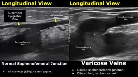 Saphenous Vein Doppler Ultrasound Normal Vs Abnormal | Varicose Veins ...