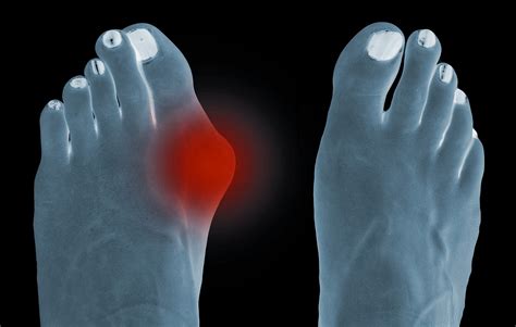 Ganglion Cyst in the Big Toe Joint [Causes, Symptoms & Best Treatment!]