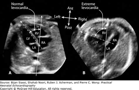 Overview of Fetal Echocardiography* | Thoracic Key