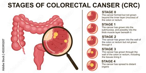 Stages of colorectal cancer CRC. Colon cancer. Colorectal oncology ...