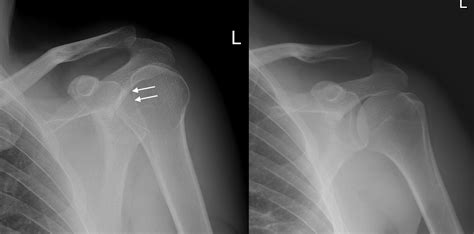 Posterior shoulder dislocation - Radiology at St. Vincent's University ...