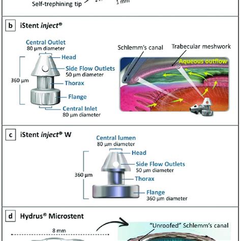 Ahmed implants. a-1 The Ahmed ® Glaucoma Valve showing its components ...