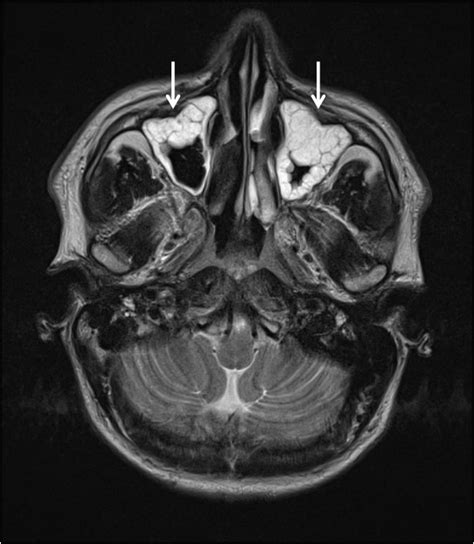 [DIAGRAM] Diagram Of Sinuses Mri - MYDIAGRAM.ONLINE