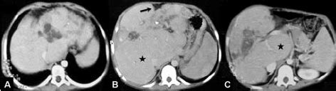 Axial CT scan of the liver shows multiple hypodense lesions in the left ...