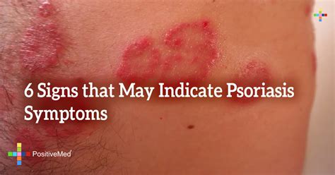 6 Signs that May Indicate Psoriasis Symptoms - PositiveMed