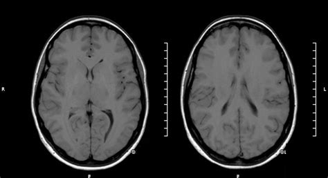 Idiopathic intracranial hypertension doc – Bobby Jones CSF