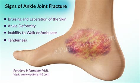 Ankle Joint Fracture|Types|Classification|Symptoms|Treatment|Recovery