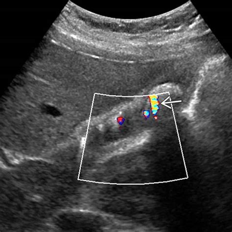 Strawberry Gallbladder Cholesterolosis Ultrasound - A Pictures Of Hole 2018