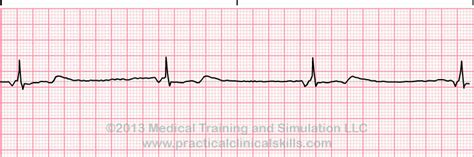 Rythme d'échappement jonctionnel | EKG.Academy