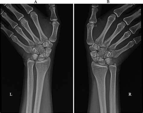 Ulnar Deviation X Ray