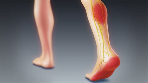 Can Sciatica Cause Foot Pain and Swelling? | Red Mountain Footcare