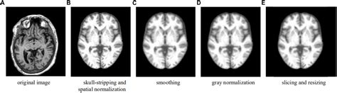 Frontiers | Early Detection of Alzheimer’s Disease Using Magnetic ...