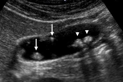 Gallbladder Polyps Treatment in Pune- Kaizen Gastro Care