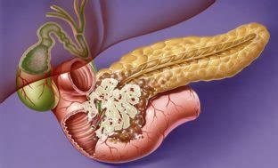 Pancreatic Cancer - Cancer Therapy Advisor