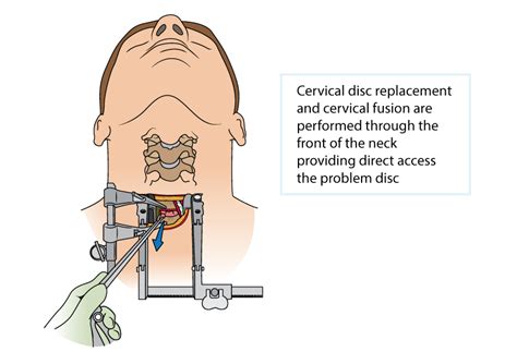 Cervical Disc Arthroplasty | Aptiva Health