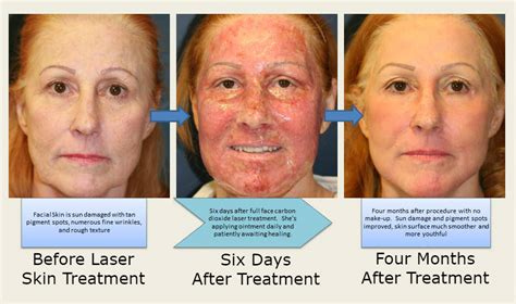 San Diego Laser Skin Resurfacing & Peels | Feel Beautiful