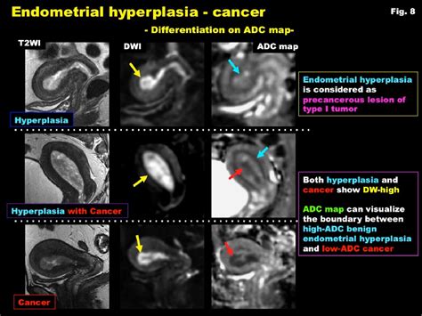 Endometrial carcinoma: Diagnostic strategy by using advanced MR ...