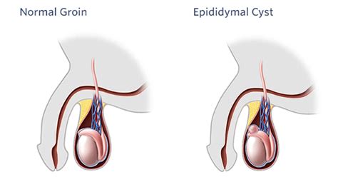 Ayurvedic Treatment for Epididymal Cyst - Symptoms, Causes & Herbal ...