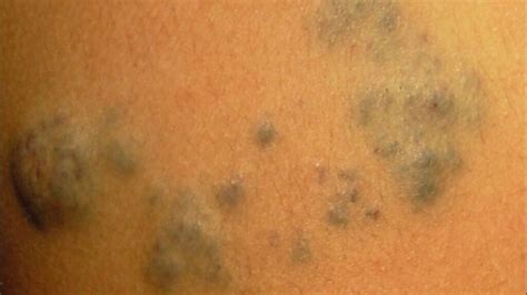 What Is Blue Rubber Bleb Nevus Syndrome? - Laurel Clinical