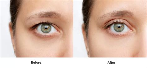 Botox for Hooded Eyes (What to Expect with Before & After Pics)