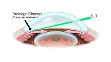 Selective Laser Trabeculoplasty (SLT) for Glaucoma - South Bay ...