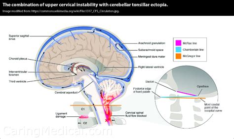 Cerebellar Tonsil Herniation