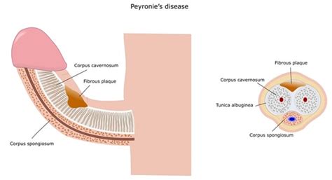 Peyronies Disease - Dr Anish Kumar Gupta