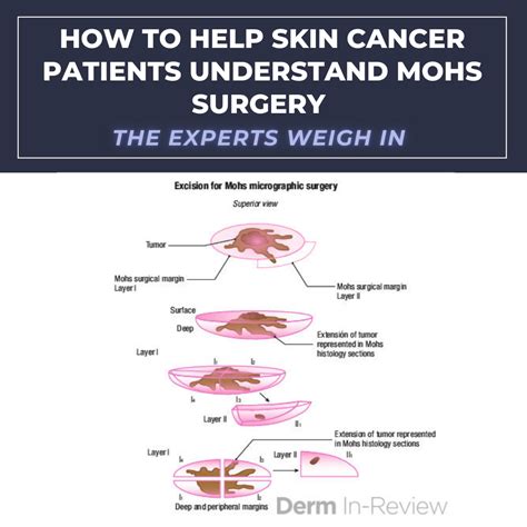 How to Help Skin Cancer Patients Understand Mohs Surgery | The Experts Weigh In - Next Steps in ...