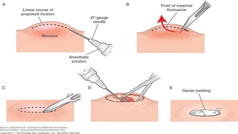 Incision and drainage | PPT