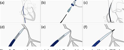 Figure 3 from Guidance of transseptal punctures for left heart interventions using personalized ...