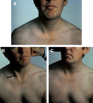 Spinal Accessory Nerve Injury Symptoms