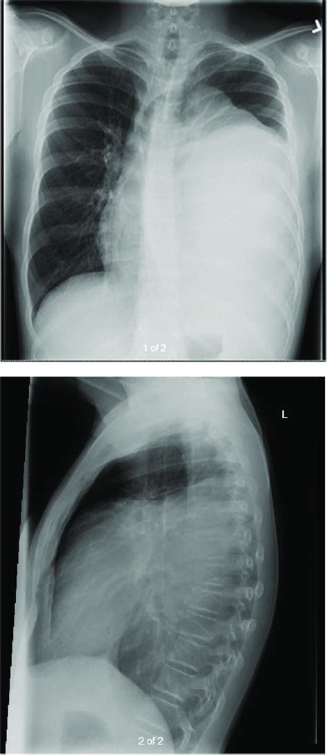 Anterior-posterior (1a) and lateral (1b) chest x-ray views revealing a... | Download Scientific ...