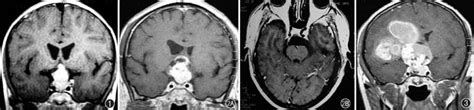 Rhoda's CT/MRI Procedures: Craniopharyngioma