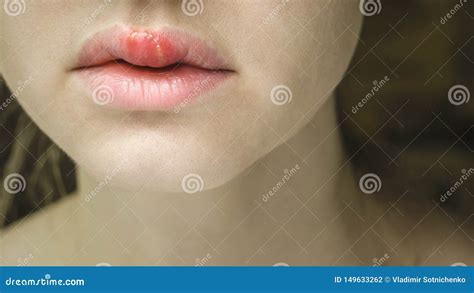 Herpes Royalty-Free Stock Photo | CartoonDealer.com #7246161