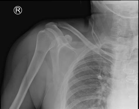 Shoulder dislocation: Lightbulb sign, Chest X-ray and Post-Reduction ...