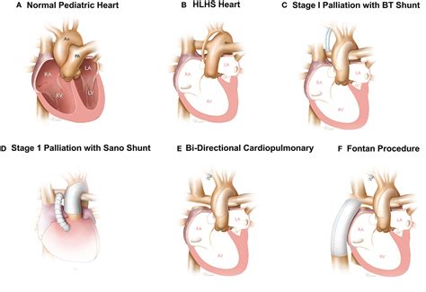 Cardiovascular Complications Of Down Syndrome: Scoping, 55% OFF