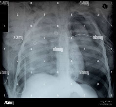 Trauma Chest X Ray