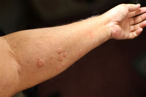 Skin Rashes COVID 19 Pandemic | Dr. Michael Steppie