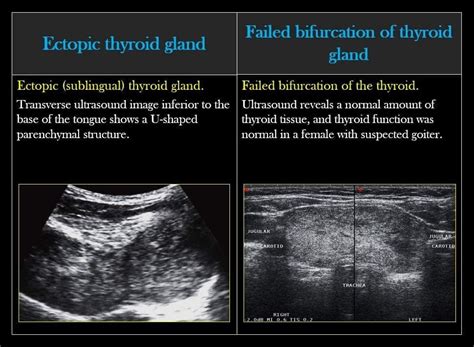 Thyroid Ultrasound, Sonography, Thyroid Gland, Medical, Quick, Crunches, Thyroid, Medicine