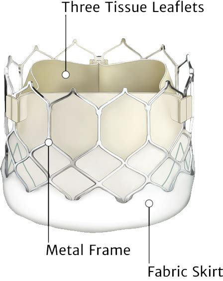 SAPIEN 3 Valve | Pulmonary Valve Replacement