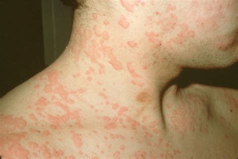 Medical Pictures Info – Urticaria